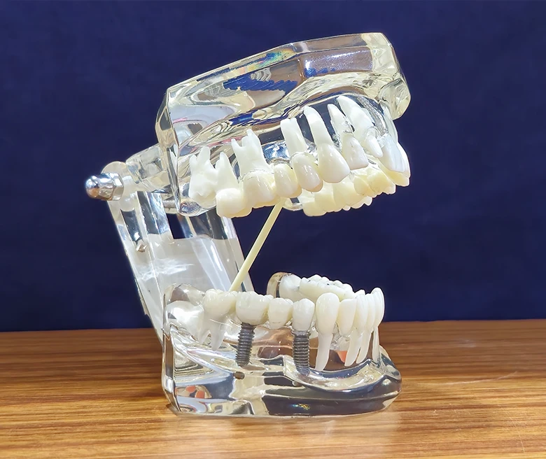 What Are Dental Implans
